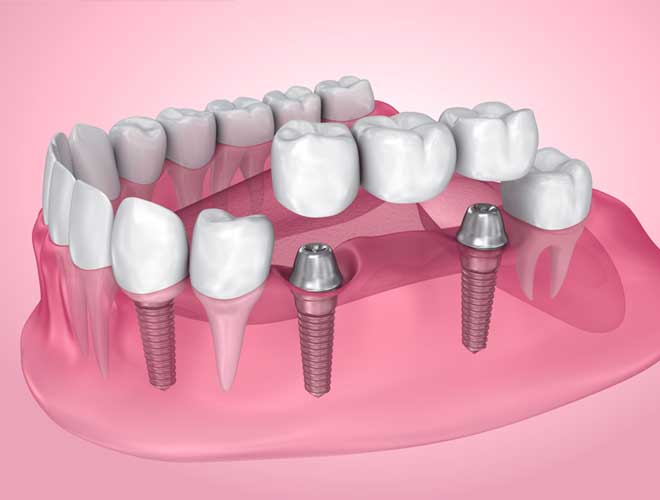 Dental-Implants-&-Crowns