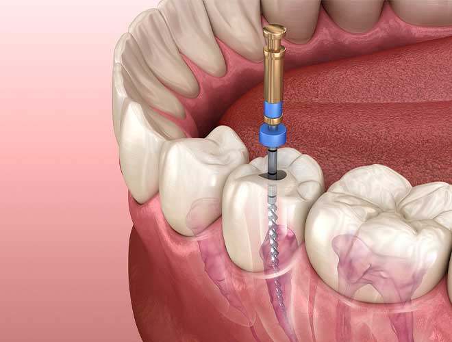 Root-Canal-Treatment