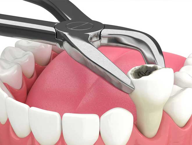 Tooth-Extraction
